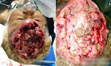 内部寄生虫最新版本更新：有哪些新内容值得期待